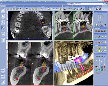 Implant Planning