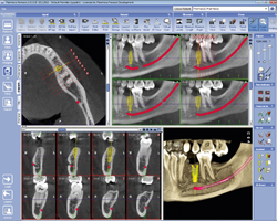 Implant image