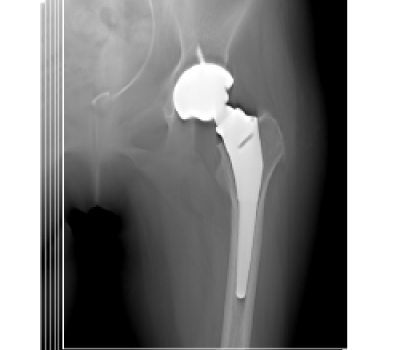 Tomosynthesis Update