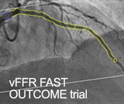 Local Pattern Vffr Shimadzu Medical Systems - vFFR FAST OUTCOME trial