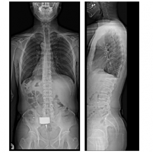 Slot scan digital radiography
